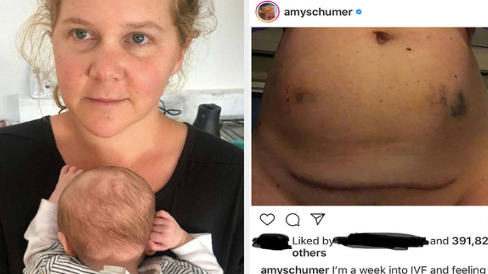 Amy Schumer Announces She’s Undergoing IVF