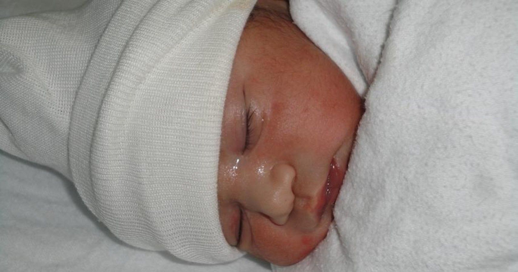Newborn sleeping, and they might have some skin discoloration.