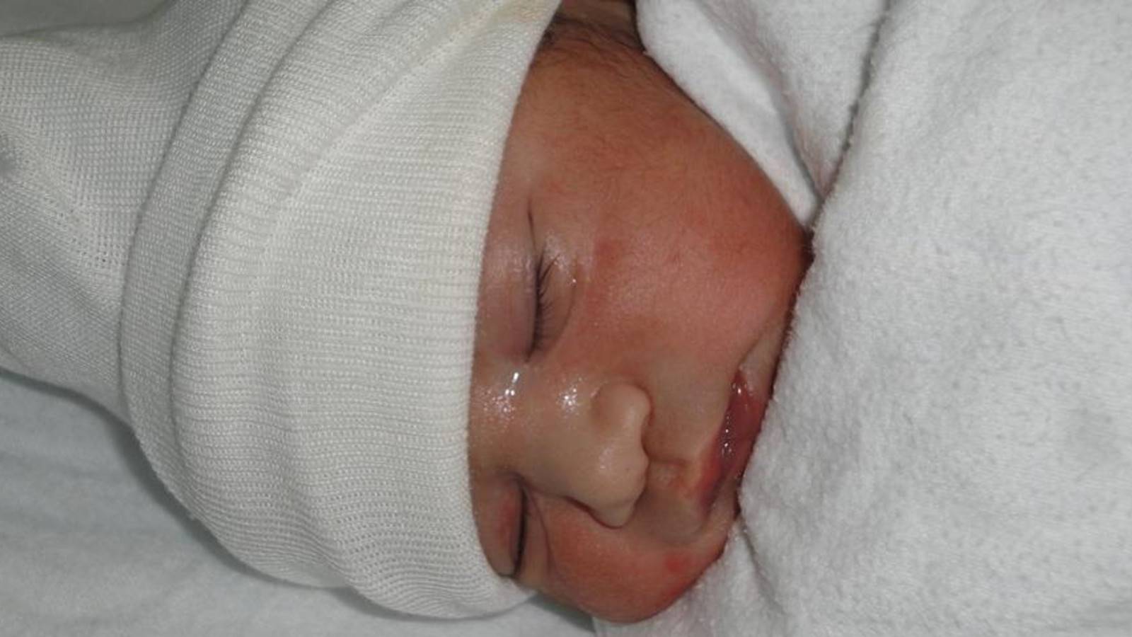 Skin Discoloration In Newborns: What It Usually Means