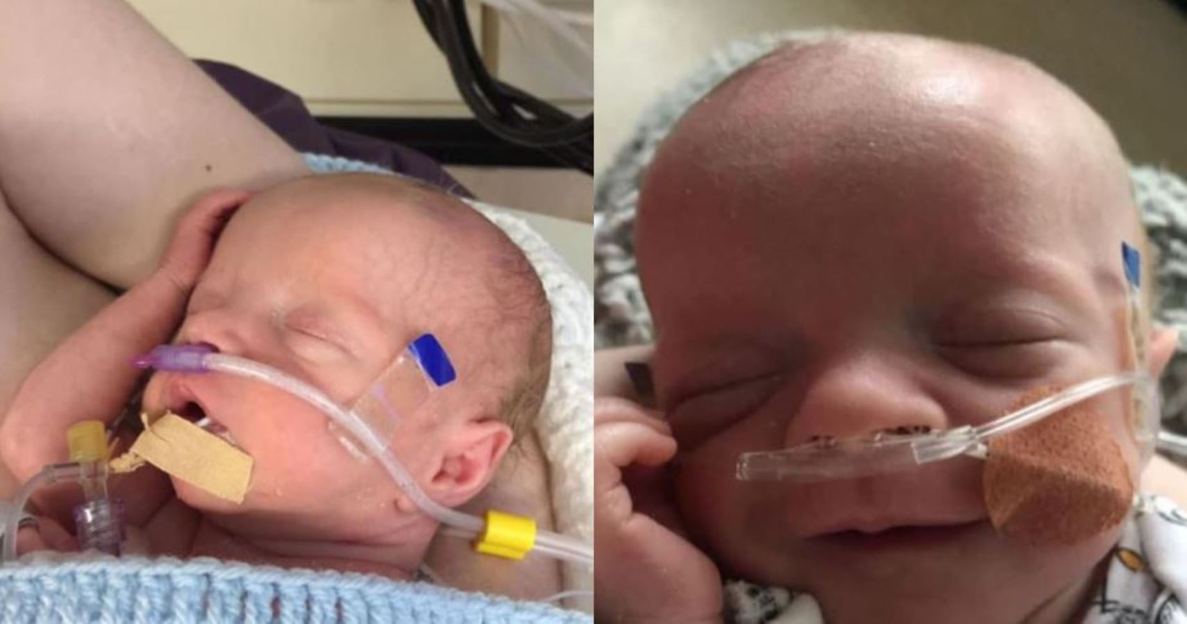 baby born four heart defects and organs outside body survives