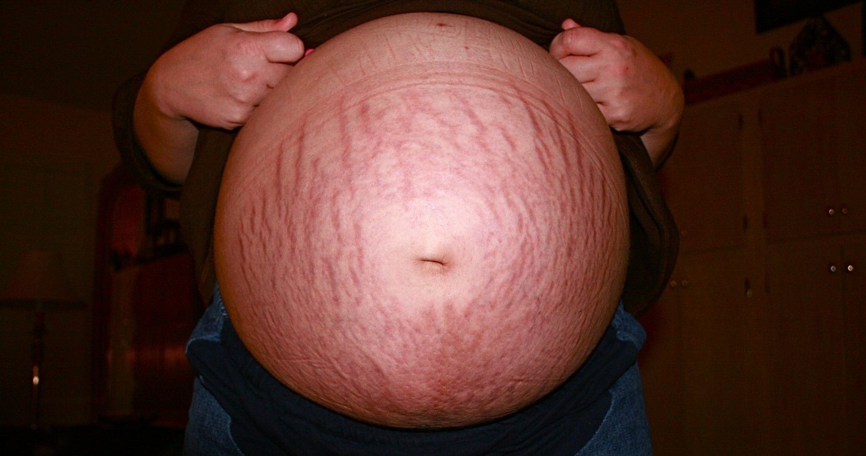 Products That Can Help Get Rid Your Stretch Marks Overnight 5168