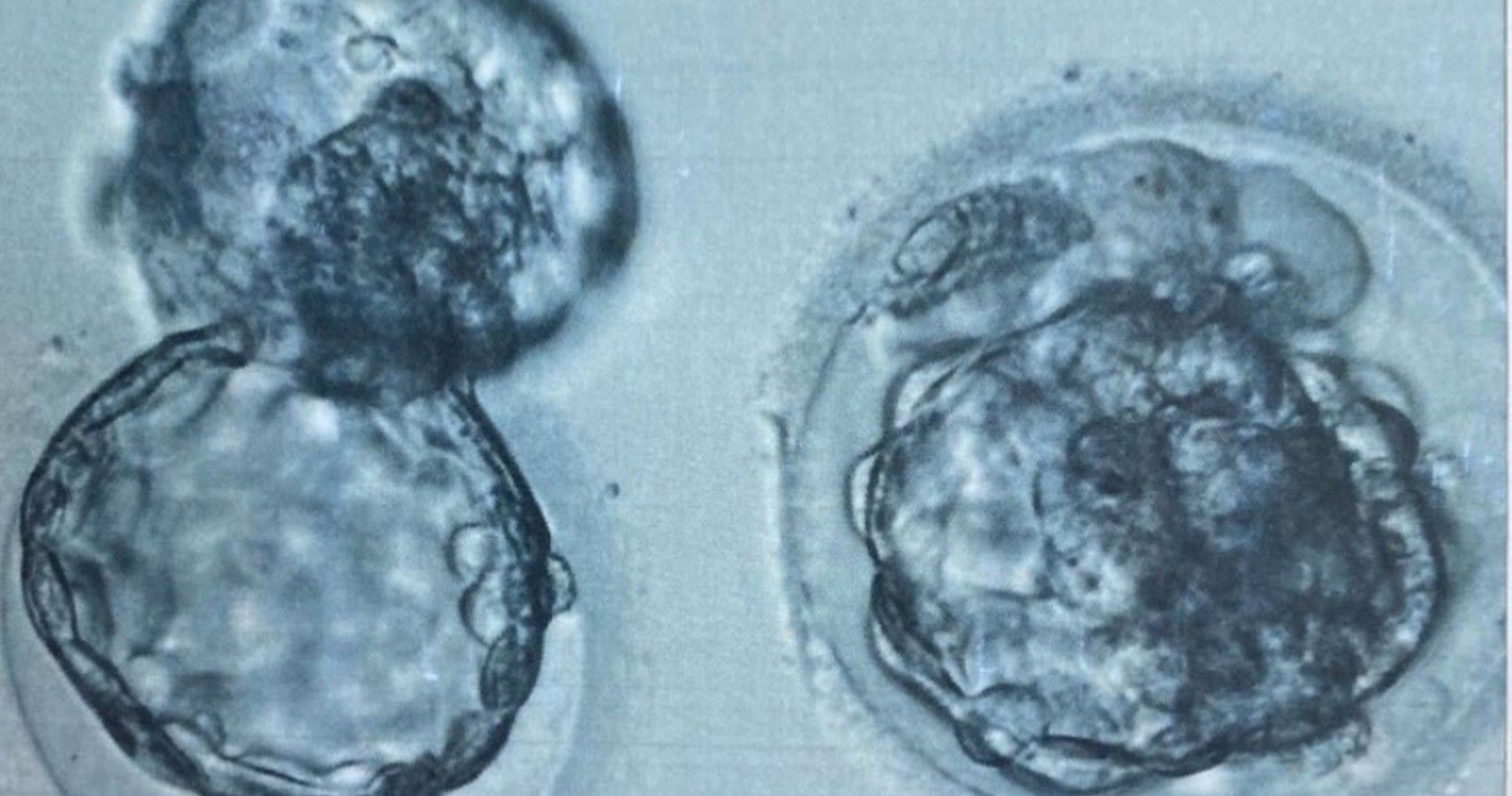 Frozen Embryo Transfers Linked To High Blood Pressure In Pregnancy