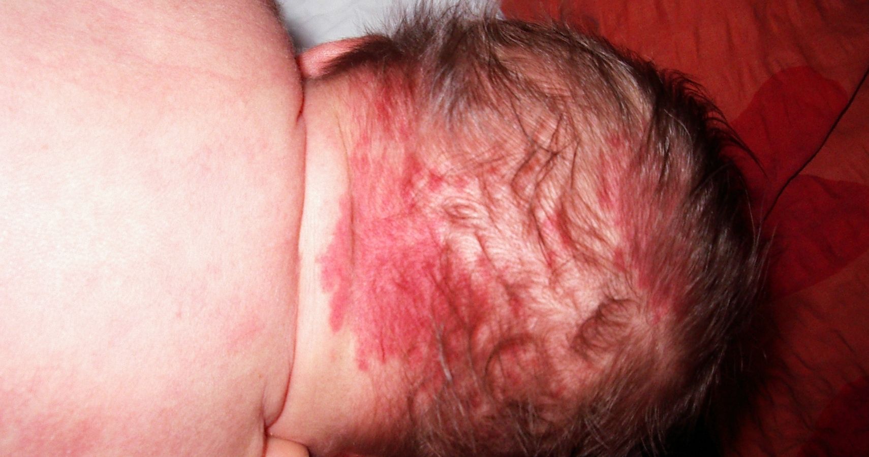 birthmarks in babies