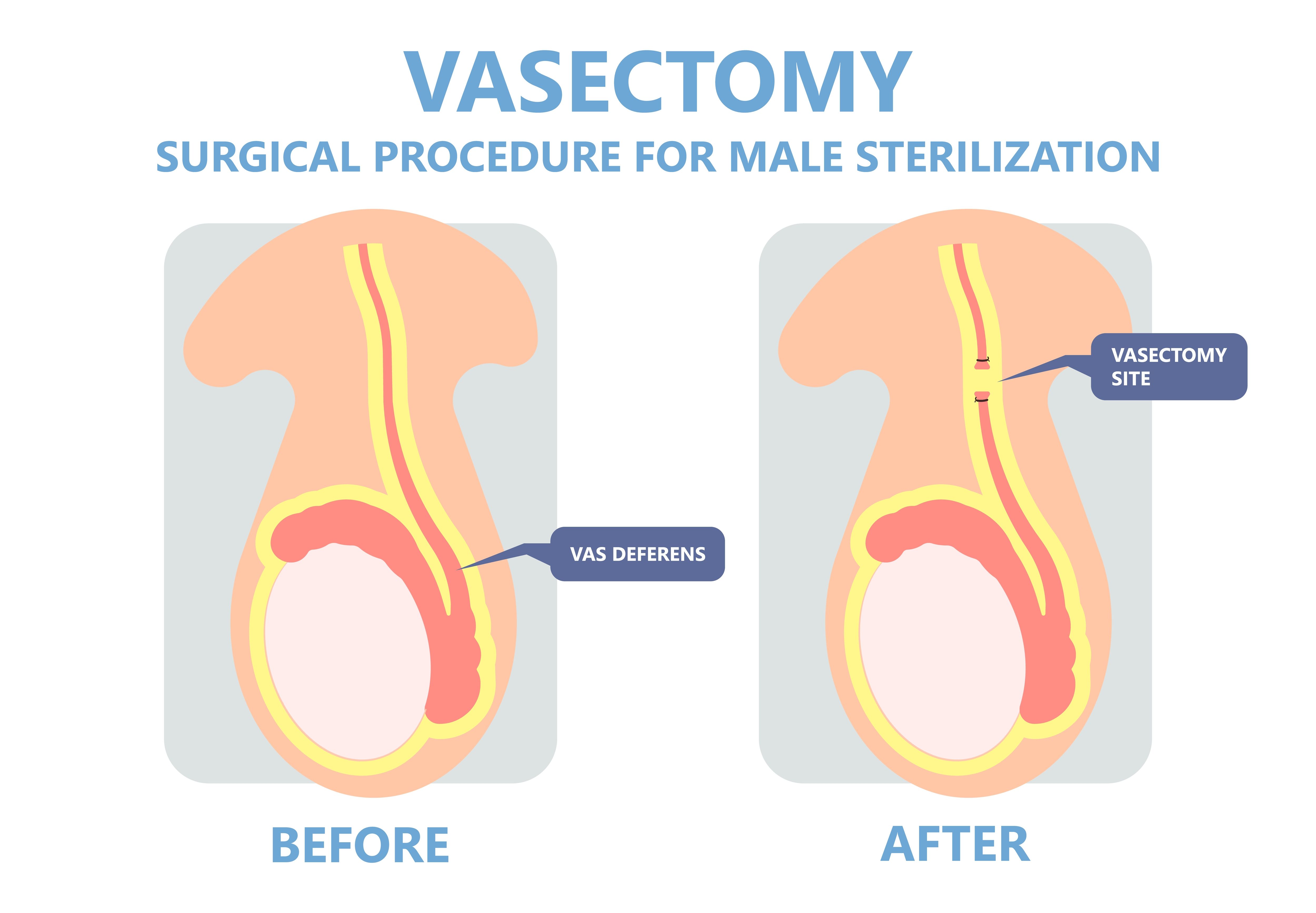 How Much Out Of Pocket Does A Vasectomy Cost