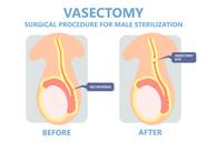 Having Children After Vasectomy Facts